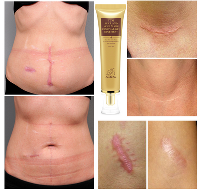 NATURAL STRETCH MARKS AND SCAR REMOVAL GEL
