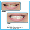 PURE WHITE ™ -TEETH WHITENING PEN
