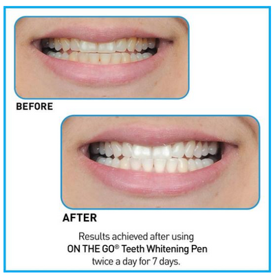 PURE WHITE ™ -TEETH WHITENING PEN
