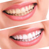 [LIMITED STOCKS] NEW & IMPROVED TEETH WHITENING KIT