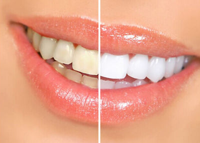 PURE WHITE ™ -TEETH WHITENING PEN